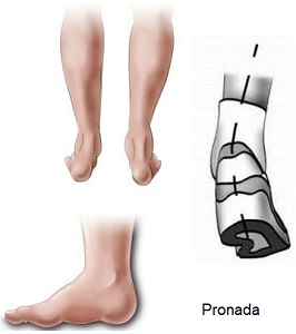 pisada supinada pode usar tenis neutro